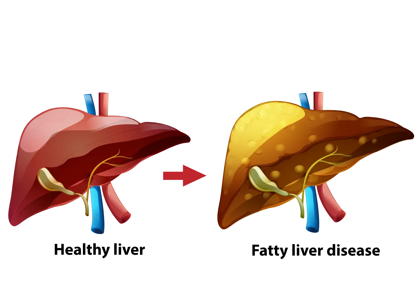 Fatty Liver Disease